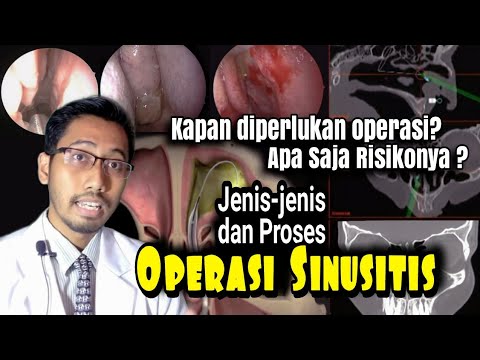 Jenis-jenis & Proses Operasi Sinusitis, Kenapa Diperlukan? #youtubehealthindonesia #youtubehealth