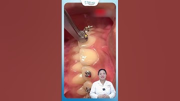 Cận Cảnh Quá Trình Gắn Mắc Cài Cho Khách Hàng | Nha Khoa Minh Châu