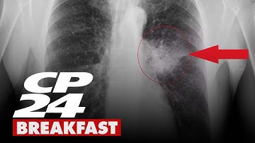 Finding lung cancer early with the help of AI