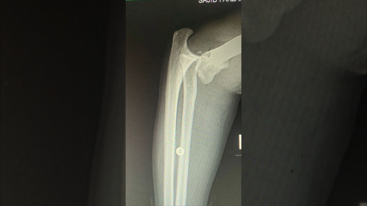 How to Reduce a Dislocated Elbow ? 