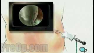 General Laparoscopy Diagnostic PreOp® Patient Engagement and Education Diagnostic Laparoscopy General