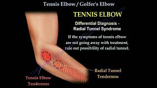 Tennis Elbow - Golfer's Elbow - Anatomy & Treatment