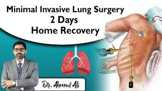 Minimal Invasive Lung Surgery: 2 Days Home Recovery