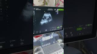 USG 3D usia kandungan 19 minggu dengan dr. Sudirmanto