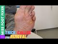 Thick Callus Removal | Miss Foot Fixer | Marion Yau