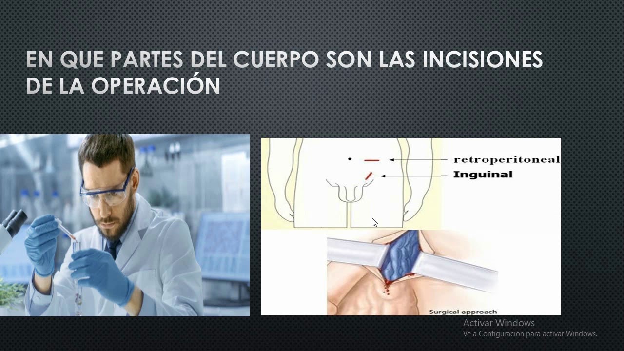Como es la operación de varicocele en el Hospital-proceso de operación