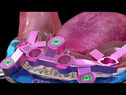 Pcube®   Stackable Guide System For Prosthetically Guided Immediate Loading