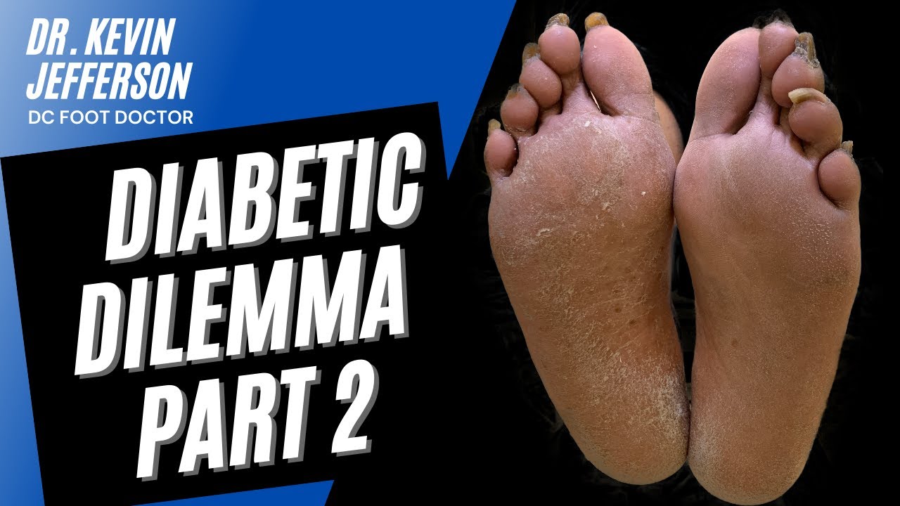 Diabetic Dilemma Part 2 Dry Skin and Calluses Caused by Diabetic