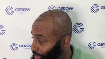 What to Expect AFTER FIRST SESSION SCALPMICROPIGMENTATION