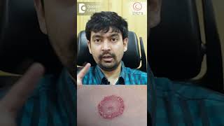 Treatment of Fungal Infection of Private Parts  Dr. Rajdeep Mysore | Doctors' Circle #shorts