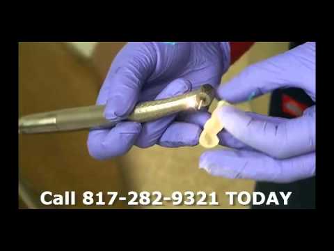 part-12-kyle-eberlein-dds-midcities-dental-temporary-bridge-polished