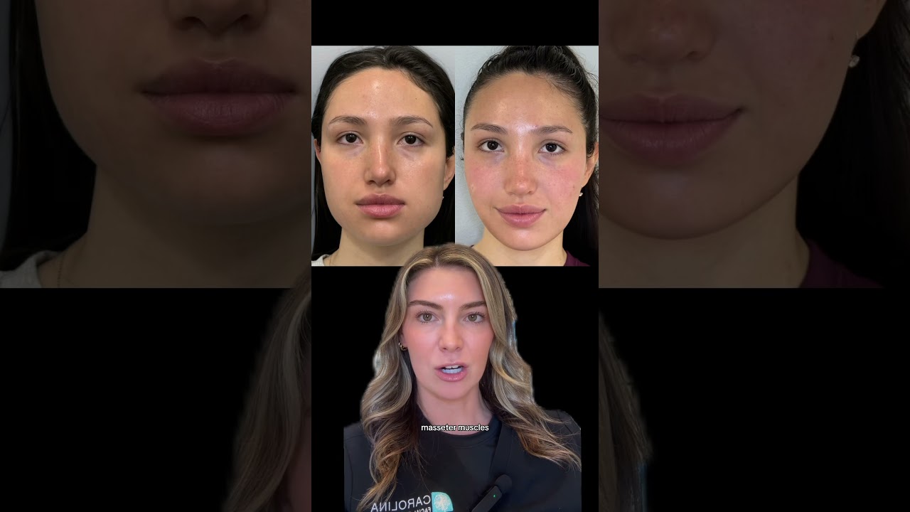Masseter Botox Transformation