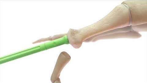 CARTIVA® Synthetic Cartilage Implant Single-Use Animation Procedure Video