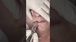 Dermapen labios: paso 2 lip filler