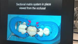 #30 MODL Composite Filling  Dr. Joel N. Janis