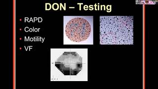 Lecture: Dysthyroid Optic Neuropathy, Management of 3rd Nerve Palsy & Neurovascular Imaging