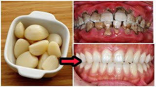 2 Minutes Whitening Your Teeth At Home ‖ Strongest Whitening Naturally Formula To Whiten Your Teeth