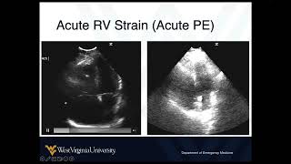 POCUS in Shock 3 - Hypovolemic and Obstructive