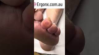 Tip Of Toe Callus Removal By Podiatrist