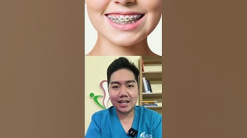 "Răng sắt" - Niềng răng kim loại có sợ bị sét đánh hay không? #nhakhoa #rang