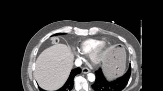 CT Ruptured Aortic Aneurysm Discussion by a Radiologist