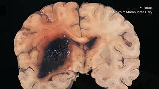 Giant Cell Bone Tumour of Skull Base in an 8-Year-Old Male - A Rare Case Report.