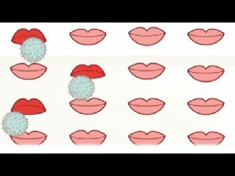 Bệnh Herpes môi