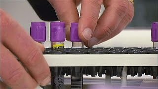 New blood test improves prostate cancer screening