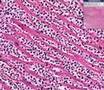 Histopathology heart myocardial infarct acute