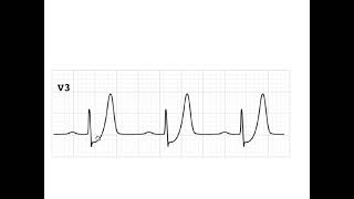 De Winter T wave : Dr. Akif Baig