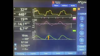 Ventilator Asynchrony: Delayed Cycling