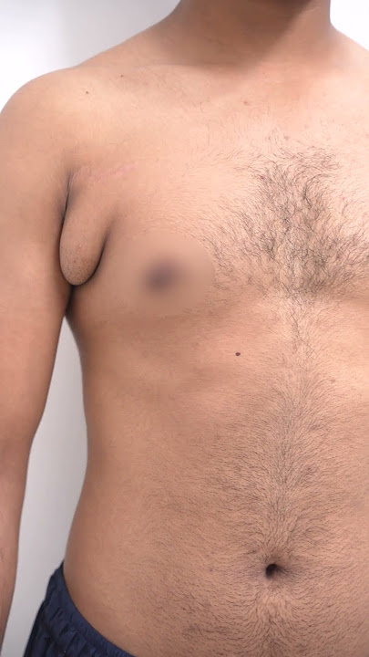 Male Unilateral Axillary fat pad removal #shorts