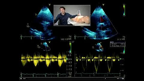 How to perform a full, comprehensive transthoracic echo study