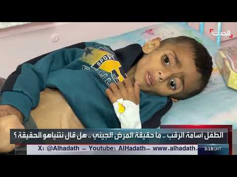 غزة: معاناة طفل بسبب الجوع وتصريحات متضاربة حول حالته