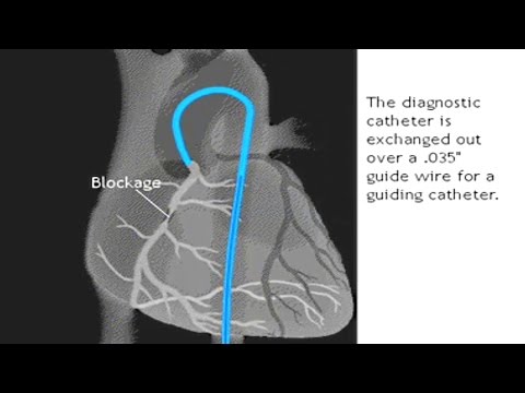 Directional Coronary Atherectomy for Coronary Artery Disease: DCA Procedure Animation Video