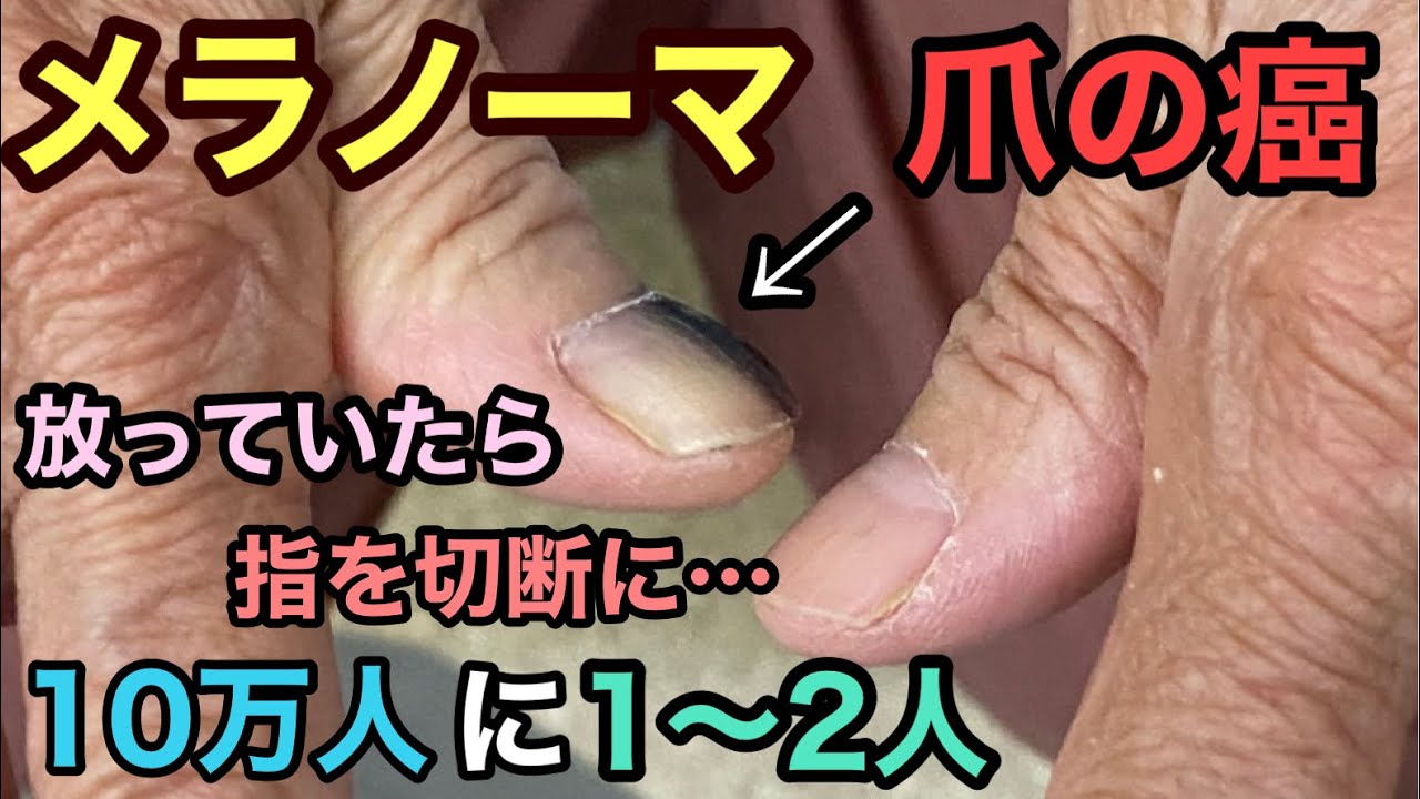 【注意喚起】これを見逃したら指を切断する事になります #メラノーマ #悪性黒色腫 #セカンドオピニオン - YouTube