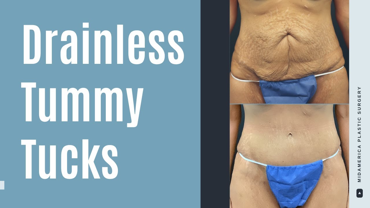 Drainless Tummy Tuck – St. Louis, MO & Glen Carbon, IL