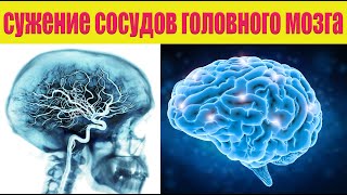 Как улучшить кровообращение головного мозга? Рецепт от сужения сосудов шеи.