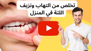 علاج التهاب و نزيف اللثة: 4 طرق منزلية