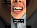 تقويم الأسنان قبل وبعد Orthodontics Oralhealth Dr Abdullah Sultan Dentist Dentist 