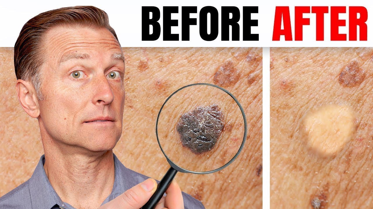 How to Remove Skin Tags and Warts Overnight   Dr Berg Explains