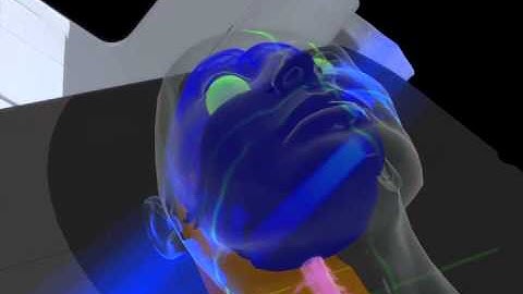 RapidArc Radiotherapy in Action