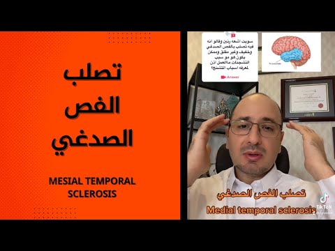 تصلب الفص الصدغي قد يسبب نوبات صرع