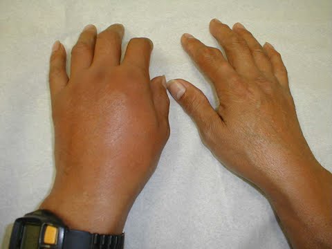 thumb mcp joint