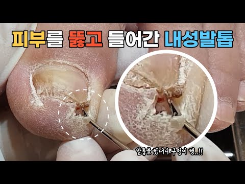 피부를 뚫고 들어간 내성발톱! most satisfying ingrown toenail