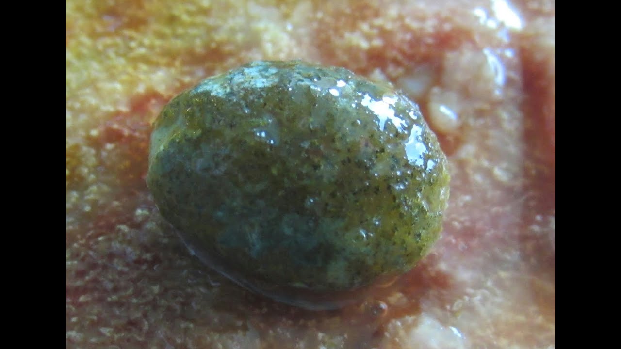 Watch Inside Of Gall bladder - Stone Removed - YouTube