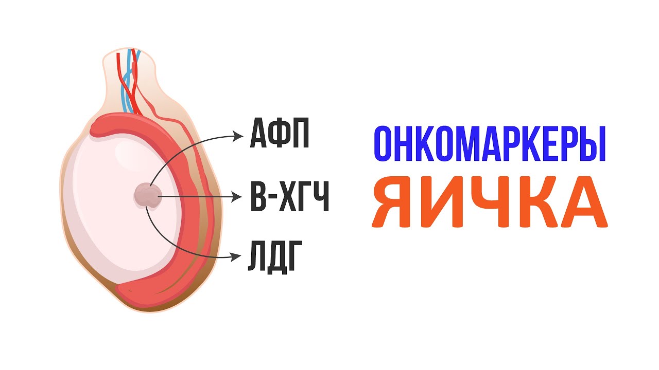 Опухло яйцо у мужчины причины. Онкомаркеры опухоли яичка.