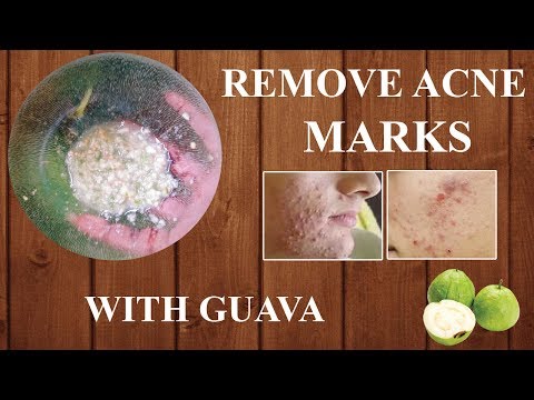 Remove acne marks with guava | Dark spots left by pimples