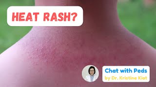 Heat Rash (Bungang Araw) in Babies and Children | Chat with Peds | Dr. Kristine Alba Kiat