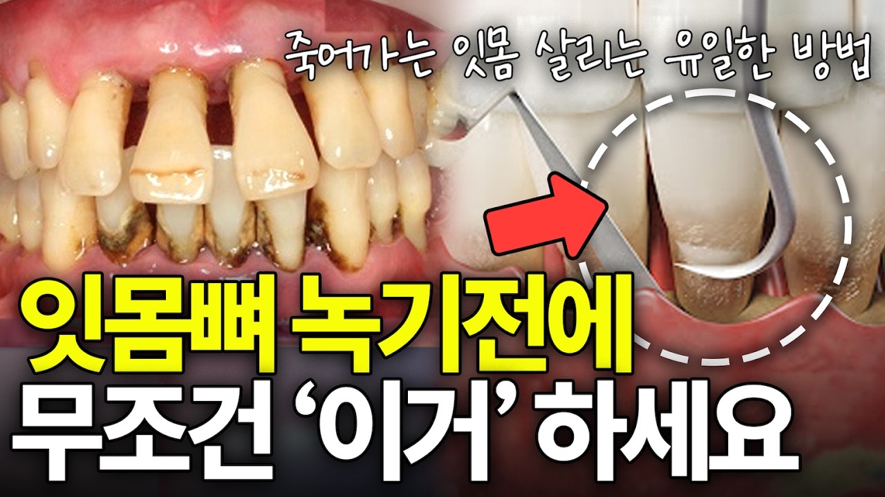 잇몸병 없애는 가장 확실한 방법